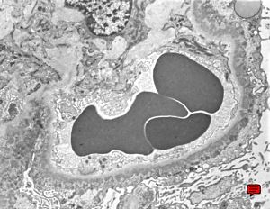  M,69y. | membranous glomerulopathy